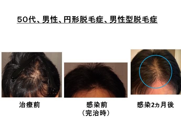 円形脱毛症　病院